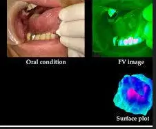 Oral Cancer Screening